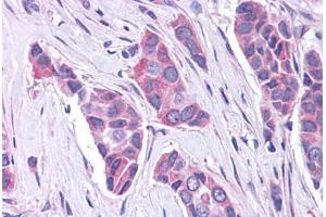 Anti-GPR30 antibody  ABIN1048795 IHC staining of human breast carcinoma.