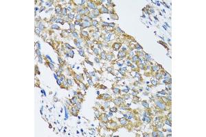 Immunohistochemistry of paraffin-embedded human lung cancer using SLC25A13 antibody (ABIN6292454) at dilution of 1:100 (40x lens). (slc25a13 Antikörper)