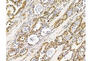 ABIN7096048 and ABIN7100110 at 1/100 staining human ovarian cancer by IHC-P. (WDR73 Antikörper)