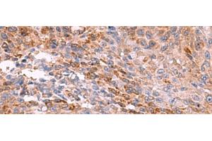 Immunohistochemistry of paraffin-embedded Human colorectal cancer tissue using PEMT Polyclonal Antibody at dilution of 1:55(x200) (PEMT Antikörper)