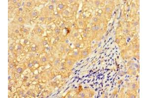 Immunohistochemistry of paraffin-embedded human liver cancer using ABIN7157008 at dilution of 1:100 (Inversin Antikörper  (AA 1-101))