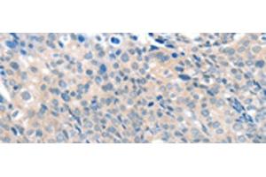 Immunohistochemistry of paraffin-embedded Human cervical cancer tissue using SLC17A6 Polyclonal Antibody at dilution of 1:100(x200) (Solute Carrier Family 17 (Vesicular Glutamate Transporter), Member 6 (SLC17A6) Antikörper)