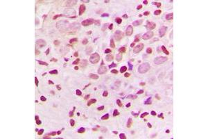 Immunohistochemical analysis of ZNF174 staining in human breast cancer formalin fixed paraffin embedded tissue section. (ZNF174 Antikörper  (Center))