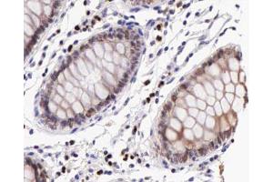 ABIN6267227 at 1/200 staining human colon cancer tissue sections by IHC-P. (IKBKB Antikörper  (pTyr199))