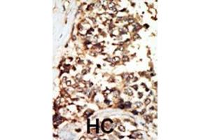 Formalin-fixed and paraffin-embedded human cancer tissue reacted with the primary antibody, which was peroxidase-conjugated to the secondary antibody, followed by DAB staining. (PKD2 Antikörper  (C-Term))