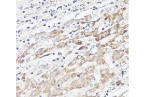 Immunohistochemistry of paraffin-embedded Human liver cancer using IGFBP1 Polyclonal Antibody at dilution of 1:100 (40x lens). (IGFBPI Antikörper)