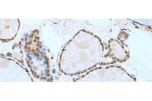 Immunohistochemistry of paraffin-embedded Human thyroid cancer tissue using L3MBTL2 Polyclonal Antibody at dilution of 1:70(x200) (L3MBTL2 Antikörper)