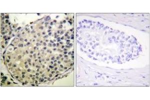 Immunohistochemistry analysis of paraffin-embedded human breast carcinoma, using eIF4G (Phospho-Ser1108) Antibody. (EIF4G1 Antikörper  (pSer1148))