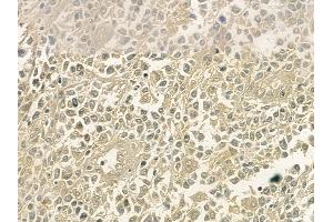 ABIN6254902 and ABIN6267061 at 1/100 staining human non-Hodgkin lymphoma by IHC-P. (NF-kB p65 Antikörper  (acLys310))