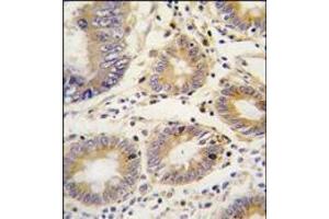 Formalin-fixed and paraffin-embedded human colon carcinoma tissue reacted with LEFTB antibody (C-term), which was peroxidase-conjugated to the secondary antibody, followed by DAB staining. (LEFTY1 Antikörper  (C-Term))