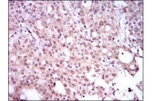Immunohistochemical analysis of paraffin-embedded cervical cancer tissues using SRY mouse mAb with DAB staining. (SRY Antikörper  (AA 1-204))