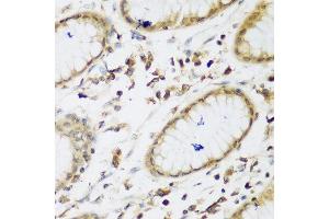 Immunohistochemistry of paraffin-embedded human gastric using UBE3A antibody at dilution of 1:200 (40x lens). (ube3a Antikörper)