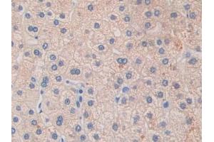 Detection of GLDC in Human Liver cancer Tissue using Polyclonal Antibody to Glycine Dehydrogenase (GLDC) (GLDC Antikörper  (AA 81-268))
