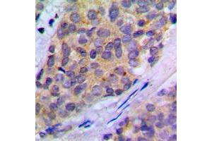 Immunohistochemical analysis of PLA2G4A (pS505) staining in human breast cancer formalin fixed paraffin embedded tissue section. (PLA2G4A Antikörper  (pSer505))