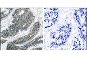 Immunohistochemistry analysis of paraffin-embedded human breast carcinoma tissue, using p62 Dok (Ab-398) Antibody.