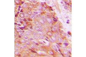 Immunohistochemical analysis of 14-3-3 zeta (pT232) staining in human breast cancer formalin fixed paraffin embedded tissue section. (14-3-3 zeta Antikörper  (C-Term, pThr232))