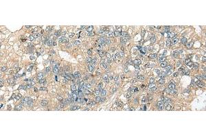 Immunohistochemistry of paraffin-embedded Human gastric cancer tissue using CASR Polyclonal Antibody at dilution of 1:60(x200)