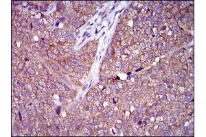 Immunohistochemical analysis of paraffin-embedded bladder cancer tissues using CLGN mouse mAb with DAB staining. (Calmegin Antikörper  (AA 249-405))
