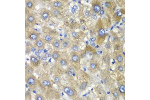 Immunohistochemistry of paraffin-embedded human liver injury using TLK2 antibody at dilution of 1:100 (x40 lens).