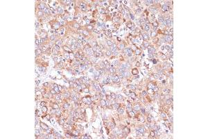 Immunohistochemistry of paraffin-embedded human liver cancer using Y antibody (ABIN6132787, ABIN6150315, ABIN6150320 and ABIN6214108) at dilution of 1:100 (40x lens). (YAP1 Antikörper  (AA 155-504))