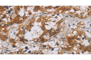 Immunohistochemistry of paraffin-embedded Human thyroid cancer using CNDP1 Polyclonal Antibody at dilution of 1:30