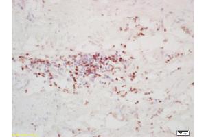 Formalin-fixed and paraffin embedded human colon carcinoma labeled with Rabbit Anti FOXD3 Polyclonal Antibody, Unconjugated (ABIN1387475) at 1:200 followed by conjugation to the secondary antibody and DAB staining