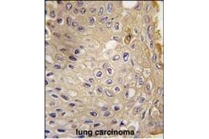 Formalin-fixed and paraffin-embedded human lung carcinoma tissue reacted with G9L1 Antibody  1814i , which was peroxidase-conjugated to the secondary antibody, followed by DAB staining. (ATG9A Antikörper  (AA 723-753))