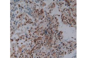 Used in DAB staining on fromalin fixed paraffin- embedded skin cancer tissue (FOS Antikörper  (AA 55-298))