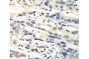 Immunohistochemistry of paraffin-embedded Human gastric cancer using NUDT1 Polyclonal Antibody at dilution of 1:100 (40x lens).