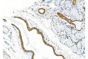 ABIN6260321 and ABIN6277297 at 1/100 staining Human esophageal cancer and adjacent normal tissues by IHC-P. (Betacellulin Antikörper  (N-Term))
