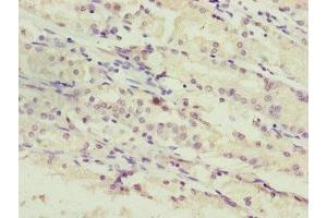 Immunohistochemistry of paraffin-embedded human gastric cancer using ABIN7169284 at dilution of 1:100 (PPP2R3C Antikörper  (Regulatory Subunit B))