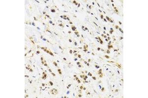 Immunohistochemistry of paraffin-embedded human breast cancer using RAD50 Antibody. (RAD50 Antikörper)