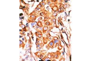 Formalin-fixed and paraffin-embedded human cancer tissue reacted with the primary antibody, which was peroxidase-conjugated to the secondary antibody, followed by AEC staining. (Glycerol Kinase Antikörper  (C-Term))