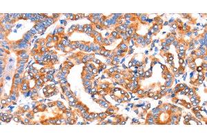 Immunohistochemistry of paraffin-embedded Human thyroid cancer tissue using SEPT4 Polyclonal Antibody at dilution 1:50 (Septin 4 Antikörper)