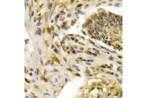 Immunohistochemistry of paraffin-embedded human esophageal cancer using IFIH1 antibody (ABIN5971229) at dilution of 1/200 (40x lens). (IFIH1 Antikörper)