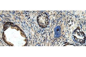 Immunohistochemistry of paraffin-embedded Human prost ate cancer tissue using ERLIN1 Polyclonal Antibody at dilution of 1:50(x200) (ERLIN1 Antikörper)