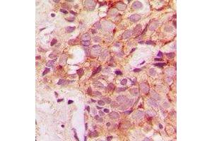 Immunohistochemical analysis of IRAK3 staining in human breast cancer formalin fixed paraffin embedded tissue section.