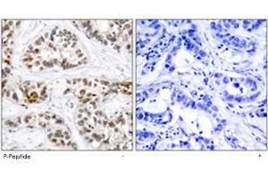 Immunohistochemical analysis of paraffin-embedded human breast carcinoma tissue using RELB (phospho S552) polyclonal antibody . (RELB Antikörper  (pSer552))