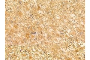 ABIN6263242 and ABIN6266551 at 1/100 staining human astrocytoma by IHC-P. (GRM7 Antikörper  (C-Term))