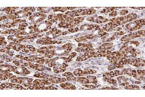 ABIN6272373 at 1/100 staining Human liver cancer tissue by IHC-P. (OR51F2 Antikörper  (C-Term))