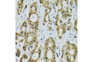 Immunohistochemistry of paraffin-embedded human rectal cancer using RPS7 antibody (ABIN5974069) at dilution of 1/100 (40x lens). (RPS7 Antikörper)