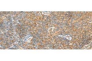 Immunohistochemistry of paraffin-embedded Human tonsil tissue using MTHFD2L Polyclonal Antibody at dilution of 1:30(x200) (MTHFD2L Antikörper)
