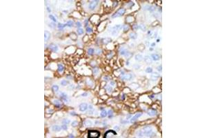 Formalin-fixed and paraffin-embedded human cancer tissue reacted with the primary antibody, which was peroxidase-conjugated to the secondary antibody, followed by DAB staining. (MAP4K1 Antikörper  (C-Term))