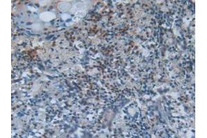 IHC-P analysis of Human Lung Cancer Tissue, with DAB staining. (SCGB1A1 Antikörper  (AA 23-91))
