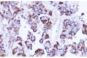 Immunohistochemistry of paraffin-embedded Human liver cancer using SHMT2 Polyclonal Antibody at dilution of 1:100 (40x lens).