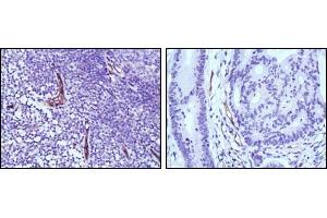 Immunohistochemical analysis of paraffin-embedded human lymph node (left) and colon cancer (right) tissues using eNOS antibody with DAB staining. (ENOS Antikörper)