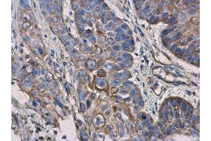 IHC-P Image IL3 Receptor alpha antibody [N2C2], Internal detects IL3 Receptor alpha protein at cell membrane and cytoplasm in human esophageal cancer by immunohistochemical analysis. (IL3RA Antikörper)