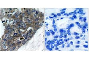 Immunohistochemical analysis of paraffin-embedded human breast carcinoma tissue, using ASK1 (Ab-966) antibody (E021134). (ASK1 Antikörper)