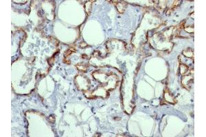 Formalin-fixed, paraffin-embedded human Angiosarcoma stained with CD31 Mouse Monoclonal Antibody (C31. (CD31 Antikörper)