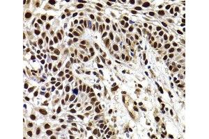 Immunohistochemistry of paraffin-embedded Human well-differentiated squamous skin carcinoma using HIRIP3 Polyclonal Antibody at dilution of 1:100 (40x lens). (HIRIP3 Antikörper)